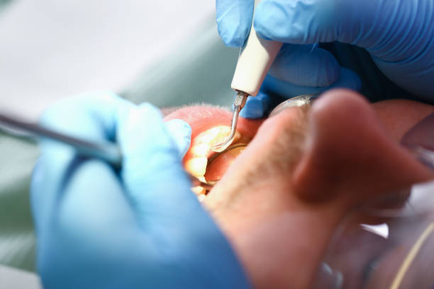 Best Emergency Treatment for Dental Infections or Abscesses in London, OH